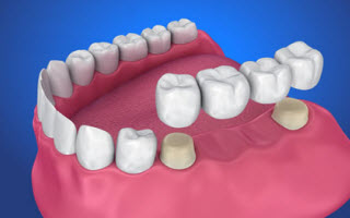 Dental Bridge